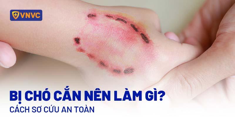 Chó dữ cắn vào tay