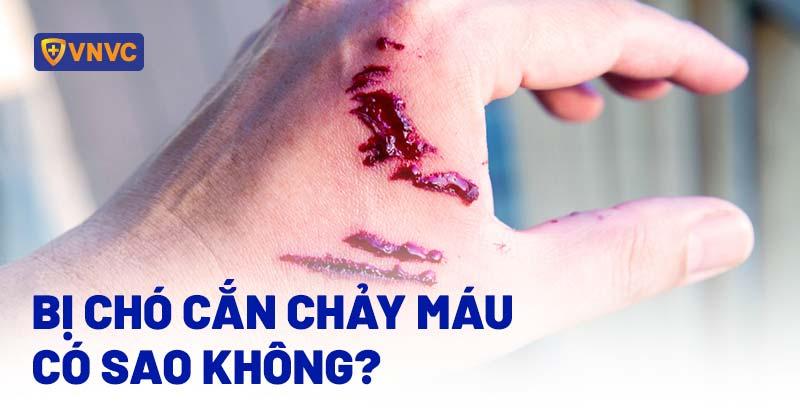 Nằm Mơ Thấy Cháy Ví Tiền: Điềm Báo Gì Về Tài Lộc?